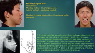 Maxillary Surgical Plan
Frontal View:
Maxillary midline:- No change needed
Anterior vertical:- No change needed
Maxillary clockwise rotation (3 mm) to enhance profile
aesthetics
E, A frontal facial view confirms that the maxillary midline matches
the upper facial midline; that there is a satisfactory lip–tooth
relationship in repose and with smile; and that there is canting of
the maxilla at the molars (2 mm) as compared with the upper
face. F, Analysis of the facial profile and the lateral cephalometric
radiograph before surgery provides useful information about facial
height, incisor inclination, A-point to B-point relationship, maxillary
and mandibular projection, and chin morphology.
 
