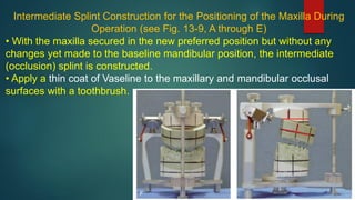Intermediate Splint Construction for the Positioning of the Maxilla During
Operation (see Fig. 13-9, A through E)
• With the maxilla secured in the new preferred position but without any
changes yet made to the baseline mandibular position, the intermediate
(occlusion) splint is constructed.
• Apply a thin coat of Vaseline to the maxillary and mandibular occlusal
surfaces with a toothbrush.
 