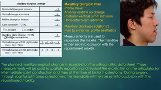 Maxillary Surgical Plan
Profile View:
Anterior vertical no change
Posterior vertical 3-mm intrusion
Horizontal 5-mm advance
Maxillary clockwise rotation (3
mm) to enhance profile aesthetics
Measurements are used to
reposition the maxilla. The mandible
is then set into occlusion with the
repositioned maxilla.
The planned maxillary surgical change is recorded on the orthognathic data sheet. These
measurements will be used to spatially reposition and reorient the maxilla first on the articulator for
intermediate splint construction and then at the time of Le Fort I osteotomy. During surgery,
through sagittal split ramus osteotomies, the mandible will then be set into occlusion with the
repositioned maxilla.
 