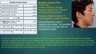 Unlike
Maxillary Surgical Plan
Profile View:
Anterior vertical no change
Posterior vertical 3-mm intrusion
Horizontal 5-mm advance
Maxillary clockwise rotation (3
mm) to enhance profile aesthetics
Measurements are used to
reposition the maxilla. The mandible
is then set into occlusion with the
repositioned maxilla.
The direct visual examination of this patient in profile as well as Andrew’s analysis The planned maxillary
surgical change is recorded on the orthognathic data sheet. These measurements will be used to spatially
reposition and reorient the maxilla first on the articulator for intermediate splint construction and then at the
time of Le Fort I osteotomy. During surgery, through sagittal split ramus osteotomies, the mandible will then
be set into occlusion with the repositioned maxilla.
 