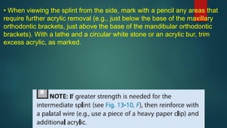 • When viewing the splint from the side, mark with a pencil any areas that
require further acrylic removal (e.g., just below the base of the maxillary
orthodontic brackets, just above the base of the mandibular orthodontic
brackets). With a lathe and a circular white stone or an acrylic bur, trim
excess acrylic, as marked.
 