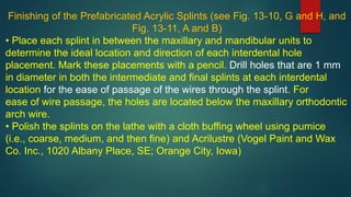 Finishing of the Prefabricated Acrylic Splints (see Fig. 13-10, G and H, and
Fig. 13-11, A and B)
• Place each splint in between the maxillary and mandibular units to
determine the ideal location and direction of each interdental hole
placement. Mark these placements with a pencil. Drill holes that are 1 mm
in diameter in both the intermediate and final splints at each interdental
location for the ease of passage of the wires through the splint. For
ease of wire passage, the holes are located below the maxillary orthodontic
arch wire.
• Polish the splints on the lathe with a cloth buffing wheel using pumice
(i.e., coarse, medium, and then fine) and Acrilustre (Vogel Paint and Wax
Co. Inc., 1020 Albany Place, SE; Orange City, Iowa)
 