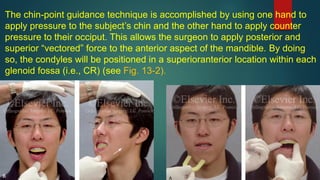 The chin-point guidance technique is accomplished by using one hand to
apply pressure to the subject’s chin and the other hand to apply counter
pressure to their occiput. This allows the surgeon to apply posterior and
superior “vectored” force to the anterior aspect of the mandible. By doing
so, the condyles will be positioned in a superioranterior location within each
glenoid fossa (i.e., CR) (see Fig. 13-2).
 