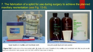 7. The fabrication of a splint for use during surgery to achieve the planned
maxillary reorientation (see Fig. 13-9).
 