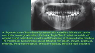 A 19-year-old man of Asian descent presented with a maxillary deficient and relative
mandibular excess growth pattern. He has an Angle Class III anterior open bite with
negative overjet malocclusion as well as a lifelong history of obstructed nasal breathing.
The maxillofacial dysmorphology causes difficulties with speech, chewing, swallowing,
breathing, and lip closure/posture, and it also negatively affects his facial aesthetics.
 