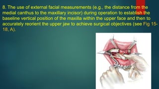 8. The use of external facial measurements (e.g., the distance from the
medial canthus to the maxillary incisor) during operation to establish the
baseline vertical position of the maxilla within the upper face and then to
accurately reorient the upper jaw to achieve surgical objectives (see Fig 15-
18, A).
 