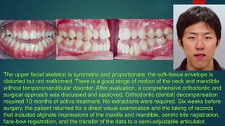 The upper facial skeleton is symmetric and proportionate; the soft-tissue envelope is
distorted but not malformed. There is a good range of motion of the neck and mandible
without temporomandibular disorder. After evaluation, a comprehensive orthodontic and
surgical approach was discussed and approved. Orthodontic (dental) decompensation
required 10 months of active treatment. No extractions were required. Six weeks before
surgery, the patient returned for a direct visual examination and the taking of records
that included alginate impressions of the maxilla and mandible, centric bite registration,
face-bow registration, and the transfer of the data to a semi-adjustable articulator.
 
