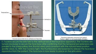 F, T-screws secure the bite fork to the vertical rod of the face-bow apparatus. The T-screws are
turned clockwise to secure the face bow after confirming that the temporal bar extensions are
parallel to the interpupillary line (frontal view) and consistent with the natural head position
(profile view). G, With the T-screws tight, the thumbscrews are loosened to release the face-bow
apparatus from the patient. The face bow is now ready to place on the articulator.
 