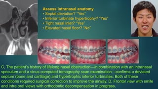 C, The patient’s history of lifelong nasal obstruction—in combination with an intranasal
speculum and a sinus computed tomography scan examination—confirms a deviated
septum (bone and cartilage) and hypertrophic inferior turbinates. Both of these
conditions required surgical correction to improve the airway. D, Frontal view with smile
and intra oral views with orthodontic decompensation in progress.
Assess intranasal anatomy
• Septal deviation? “Yes”
• Inferior turbinate hypertrophy? “Yes”
• Tight nasal inlet? “Yes”
• Elevated nasal floor? “No”
 