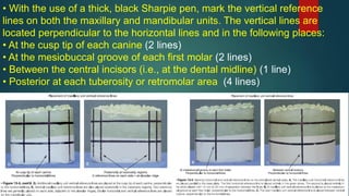 • With the use of a thick, black Sharpie pen, mark the vertical reference
lines on both the maxillary and mandibular units. The vertical lines are
located perpendicular to the horizontal lines and in the following places:
• At the cusp tip of each canine (2 lines)
• At the mesiobuccal groove of each first molar (2 lines)
• Between the central incisors (i.e., at the dental midline) (1 line)
• Posterior at each tuberosity or retromolar area (4 lines)
 