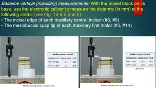Baseline vertical (maxillary) measurements: With the model block on its
base, use the electronic caliper to measure the distance (in mm) at the
following areas: (see Fig. 13-6 E and F)
• The incisal edge of each maxillary central incisor (#8, #9)
• The mesiobuccal cusp tip of each maxillary first molar (#3, #14)
 