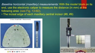 Baseline horizontal (maxillary) measurements: With the model block on its
end, use the electronic caliper to measure the distance (in mm) at the
following area: (see Fig. 13-6D).
• The incisal edge of each maxillary central incisor (#8, #9)
 