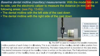 Baseline dental midline (maxillary) measurements: With the model block on
its side, use the electronic caliper to measure the distance (in mm) at the
following areas: (see Fig. 13-6G)
• The dental midline with the left side of the cast down
• The dental midline with the right side of the cast down
 