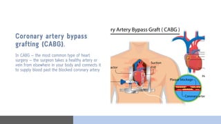 Quintuple Cabg Surgical procedures & most used Sets.pdf