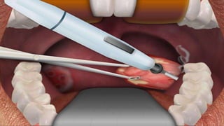 Pharynx Incision Surgical Procedures of the Pharynx | PPTX