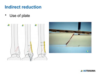 Surgical Reduction Techniques - AOTME.pptx