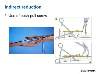 Surgical Reduction Techniques AOTME pptx Surgical Reduction Techniques AOTME pptx