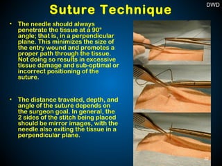 • The needle should always
penetrate the tissue at a 90°
angle; that is, in a perpendicular
plane. This minimizes the size of
the entry wound and promotes a
proper path through the tissue.
Not doing so results in excessive
tissue damage and sub-optimal or
incorrect positioning of the
suture.
• The distance traveled, depth, and
angle of the suture depends on
the surgeon goal. In general, the
2 sides of the stitch being placed
should be mirror images, with the
needle also exiting the tissue in a
perpendicular plane.
Suture Technique
32
DWD
 