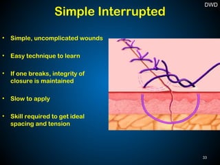 • Simple, uncomplicated wounds
• Easy technique to learn
• If one breaks, integrity of
closure is maintained
• Slow to apply
• Skill required to get ideal
spacing and tension
Simple Interrupted
33
DWD
 