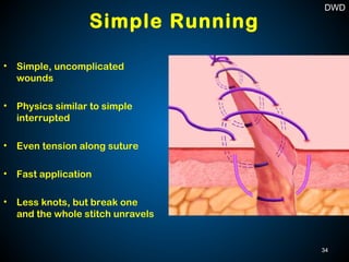 • Simple, uncomplicated
wounds
• Physics similar to simple
interrupted
• Even tension along suture
• Fast application
• Less knots, but break one
and the whole stitch unravels
Simple Running
34
DWD
 