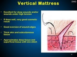 • Excellent for deep wounds and/or
wounds under high tension
• If done well, very good cosmetic
result
• Good eversion of wound edges
• Thick skin and subcutaneous
tissue
• Approximates deep tissue and
superficial tissue with one stitch
Vertical Mattress
37
DWD
 