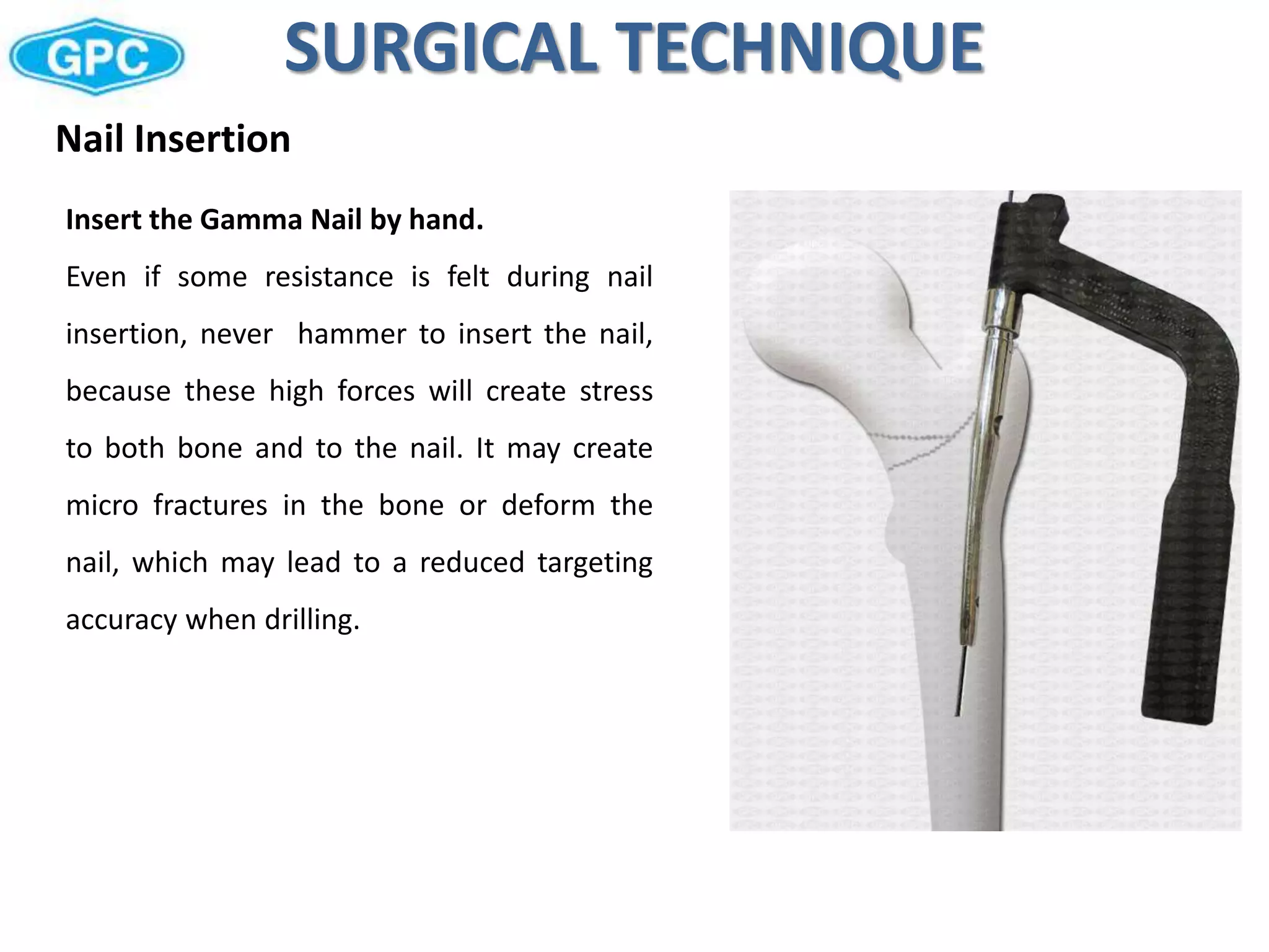 Surgical technique for gama nail | PPTX