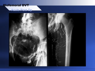 Acute Post Op
Iliofemoral DVT
 