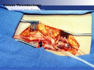 Femoral Vein Exposure
Venous Thrombectomy
 