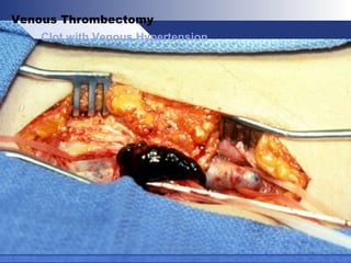Clot with Venous Hypertension
Venous Thrombectomy
 