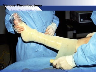 Leg Compression
Venous Thrombectomy
 