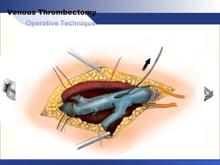 Operative Technique
Venous Thrombectomy
 