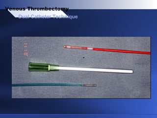 Dual Catheter Technique
Venous Thrombectomy
 