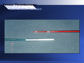 Dual Catheter Technique
Venous Thrombectomy
 