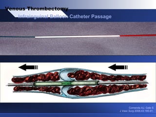 Comerota AJ, Gale S
J Vasc Surg 2006;43:185-91.
Infrainguinal Balloon Catheter Passage
Venous Thrombectomy
 