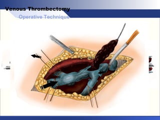 Operative Technique
Venous Thrombectomy
 