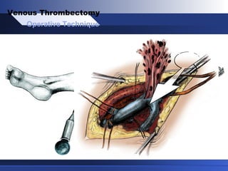 Operative Technique
Venous Thrombectomy
 