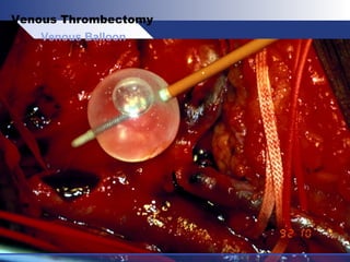 Venous Balloon
Venous Thrombectomy
 