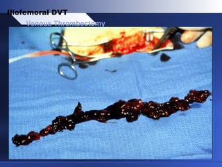 Venous Thrombectomy
Iliofemoral DVT
 