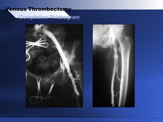 Completion Phlebogram
Venous Thrombectomy
 