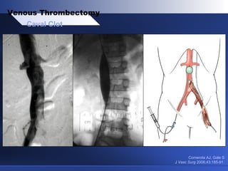 Comerota AJ, Gale S
J Vasc Surg 2006;43:185-91.
Caval Clot
Venous Thrombectomy
 