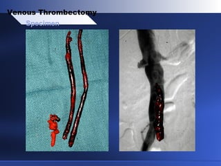 Specimen
Venous Thrombectomy
 