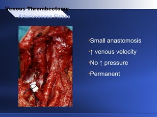 •Small anastomosis
•↑ venous velocity
•No ↑ pressure
•Permanent
Arteriovenous Fistula
Venous Thrombectomy
 