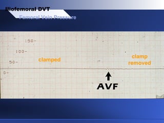 clamped
clamp
removed
Femoral Vein Pressure
Iliofemoral DVT
 