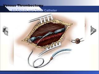 AV Fistula and Distal Catheter
Venous Thrombectomy
 