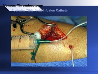 Posterior Tibial Vein Infusion Catheter
Venous Thrombectomy
 