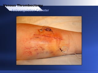 Anticoagulation Catheter
Venous Thrombectomy
 