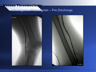 Infrainguinal Phlebogram – Pre Discharge
Venous Thrombectomy
 