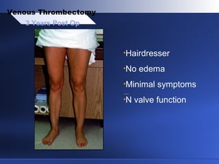 3 Years Post Op
Venous Thrombectomy
•Hairdresser
•No edema
•Minimal symptoms
•N valve function
 