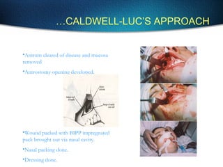 …CALDWELL-LUC’S APPROACH
•Antrum cleared of disease and mucosa
removed
•Antrostomy opening developed.
•Wound packed with BIPP impregnated
pack brought out via nasal cavity.
•Nasal packing done.
•Dressing done.
 