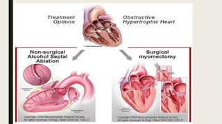 Hypertrophic Obstructive Cardiomyopathy (HOCM) | PPTX